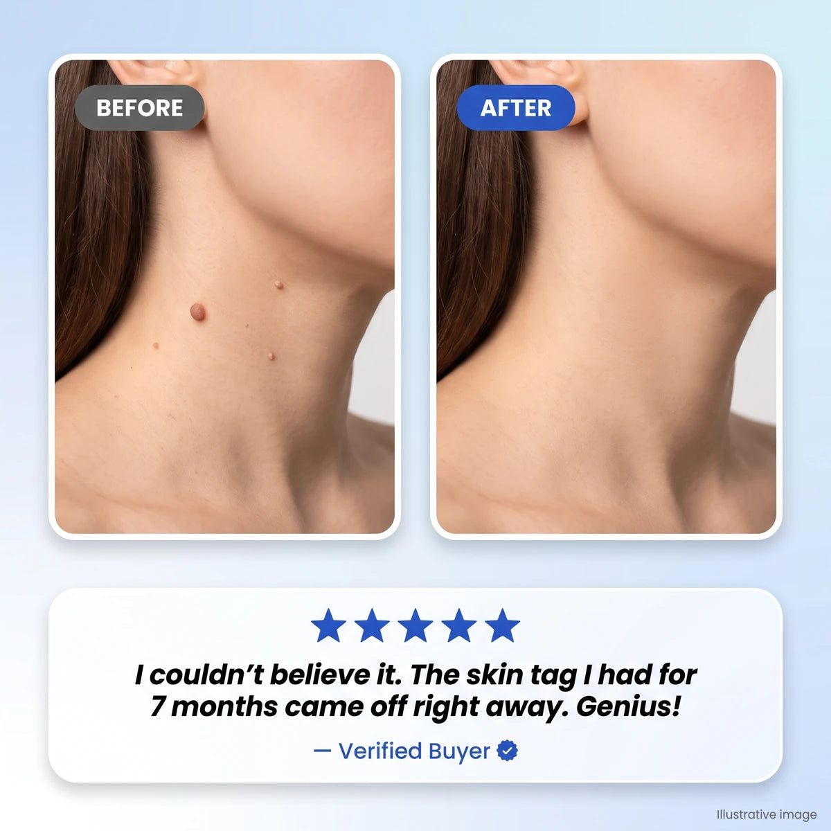 The Nuzzie Pen - Remove Imperfections, Instantly!