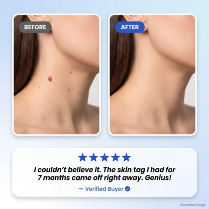 The Nuzzie Pen - Remove Imperfections, Instantly!